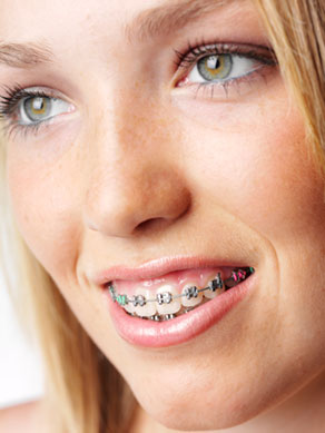 Oral Hygiene Tips for Better Braces Care