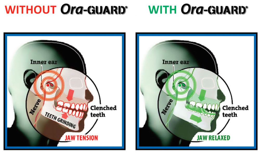 New Nighttime Grind Guard Relieves Jaw Pain